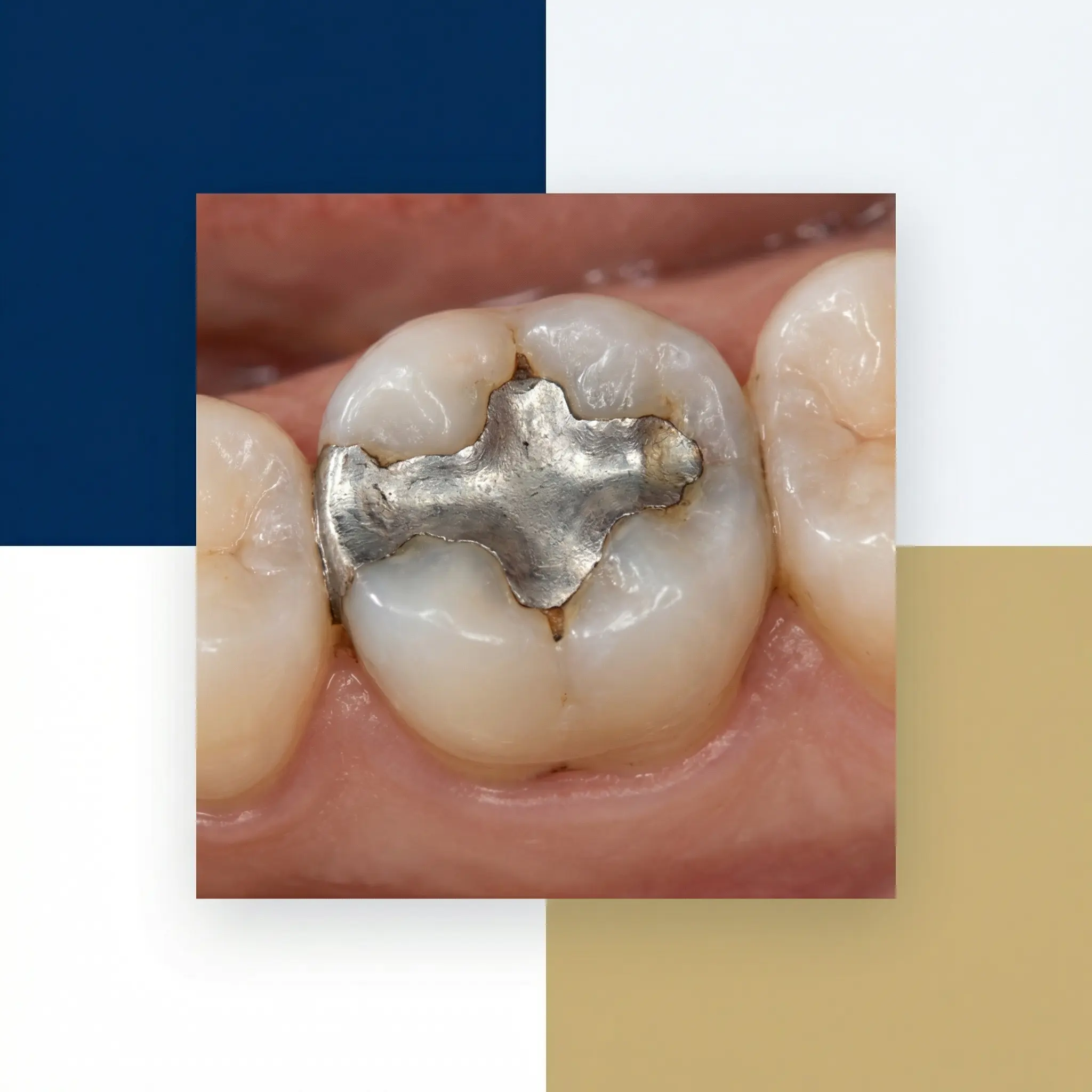 anciennes restaurations à surveiller