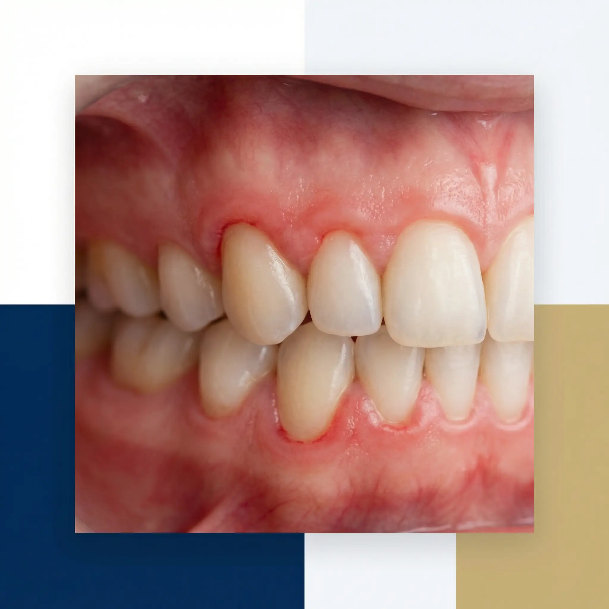 inflammation gingivale