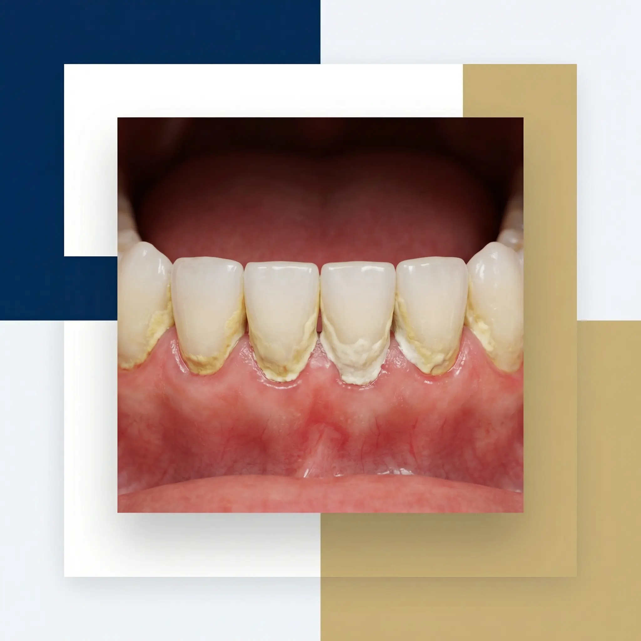 tartre ou plaque importante