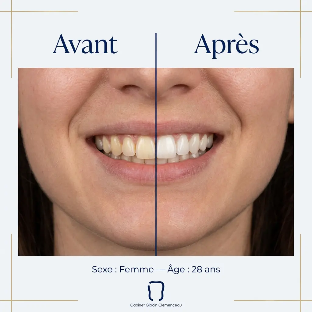 blanchiment dentaire avant apres femme 28ans