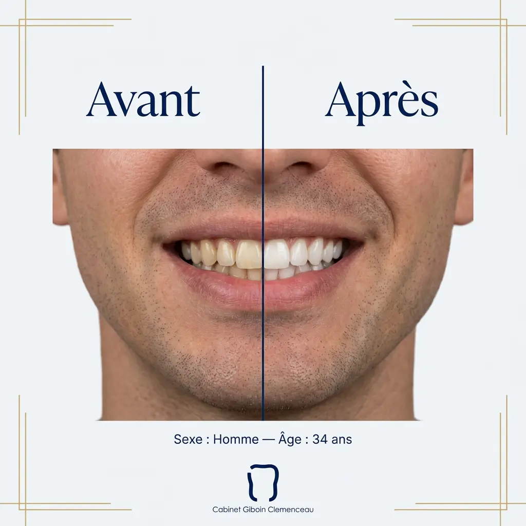 blanchiment dentaire avant apres homme 34ans
